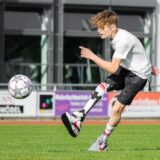 Junge mit Prothese am Bein spielt Fußball